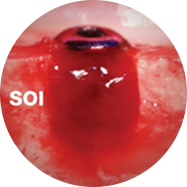 SOI 표면